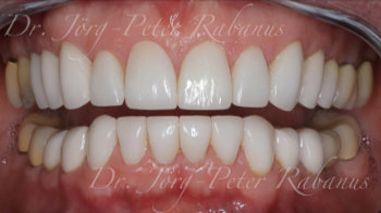 retracted lips after oral rehabilitation with porcelain veneers