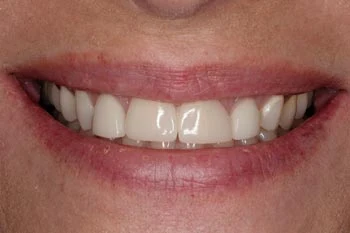 not the best porcelain veneers by other dentist