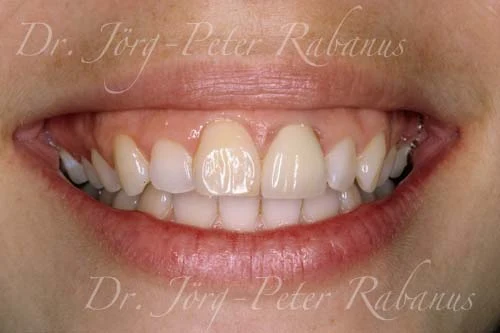 before porcelain replacement for yellow dental restorations