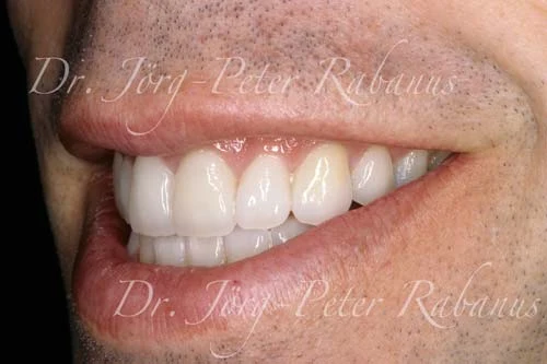 dingy teeth corrected with porcelain laminates