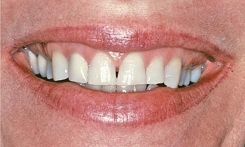 flattened smile line worn teeth