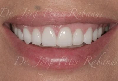 small teeth gummy smile after porcelain veneers