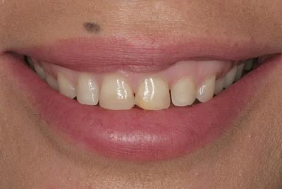 small teeth gummy smile before porcelain veneers