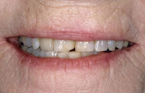 old teeth before smile rejuvenation