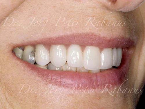 porcelain restorations for old teeth and dental restorations