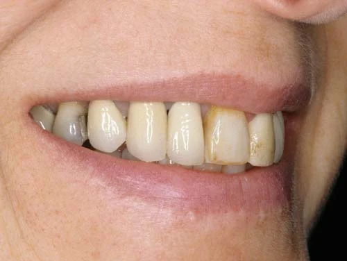 old-teeth-dental-restorations