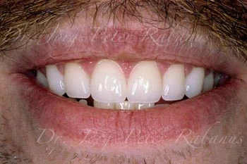 porcelain veneers and gum lift to correct gummy smile