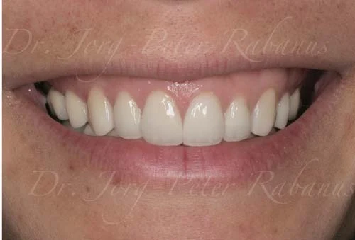 stained teeth with porcelain veneers