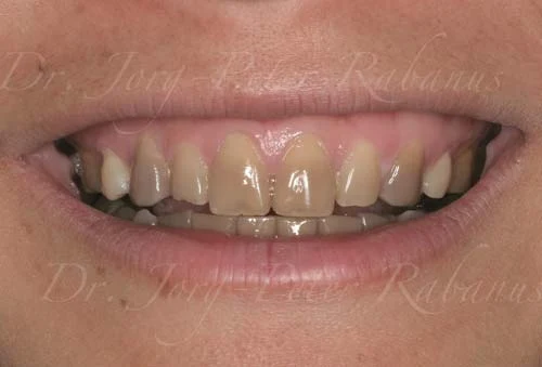 cosmetic dentistry for stained teeth
