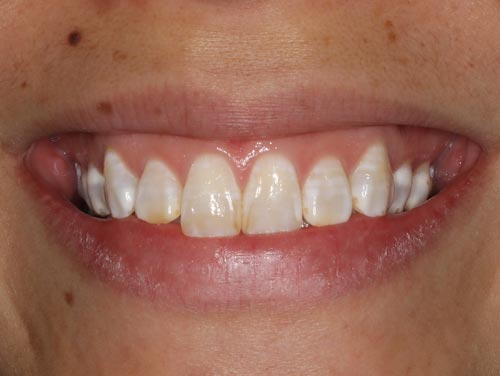 best porcelain veneers 3