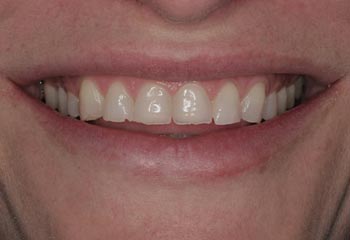 best porcelain veneers for severely worn teeth