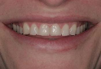 best porcelain veneers for severely worn teeth