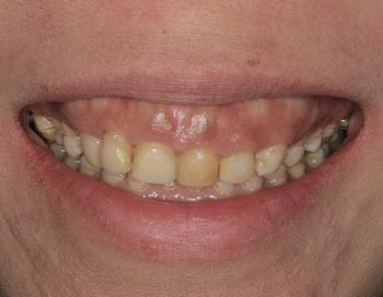 gummy smile tetracycline stained teeth