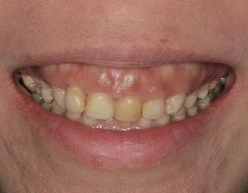 gummy smile tetracycline stained teeth
