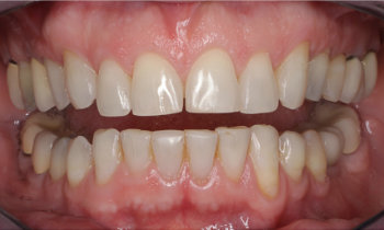 retracted lips before oral rehabilitation with porcelain veneers