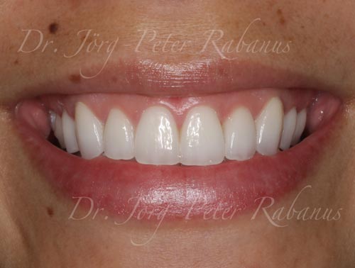 best porcelain veneers 4