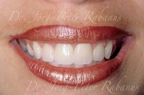 porcelain replacement for yellow dental restorations