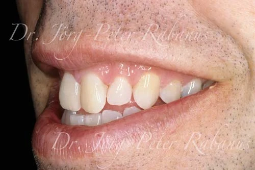 dingy teeth before smile design treatment