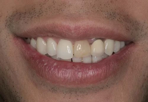 old dental crown and dark tooth