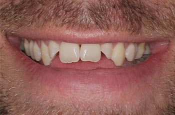 open bite with dingy teeth prior to dental laminates