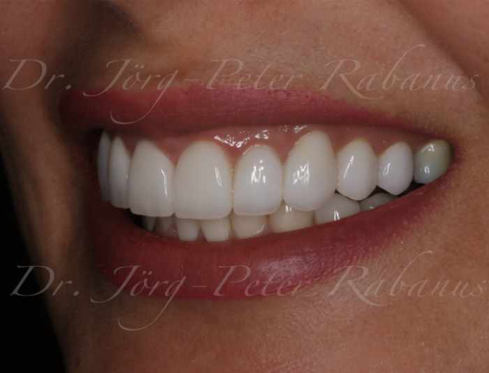 porcelain veneers gummy smile after