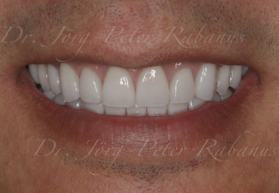 porcelain veneers successfully masked the dork tooth color