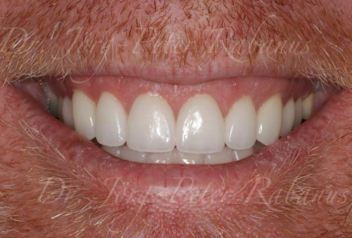teeth restored with porcelain veneers