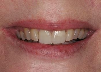 aged teeth prior to smile makeover with porcelain veneers