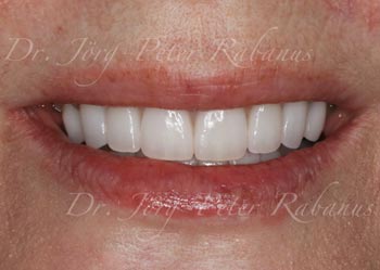 smile makeover with best porcelain veneers for aged teeth