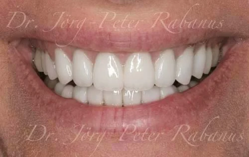 stained and misaligned teeth after smile design