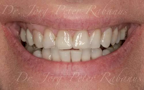 stained and misaligned teeth